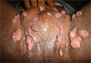 genital warts